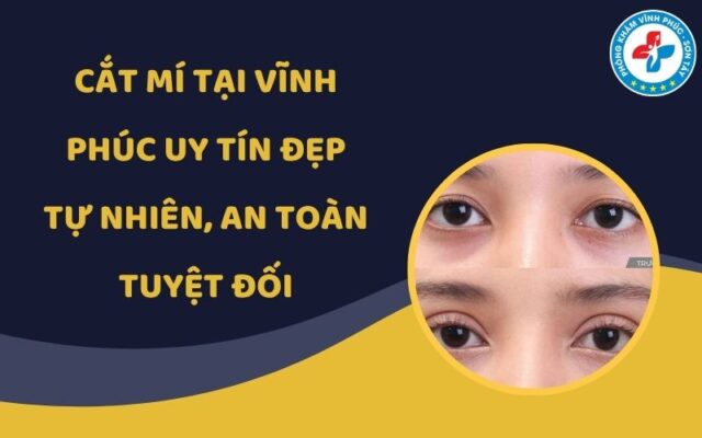 Cắt mí tại Vĩnh Phúc