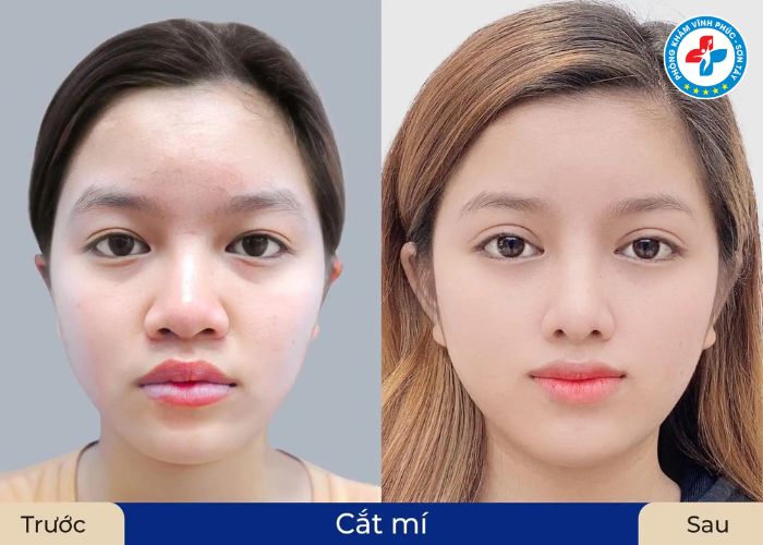 Cắt mí tại Vĩnh Phúc (2) Cắt mí tại Vĩnh Phúc (2)