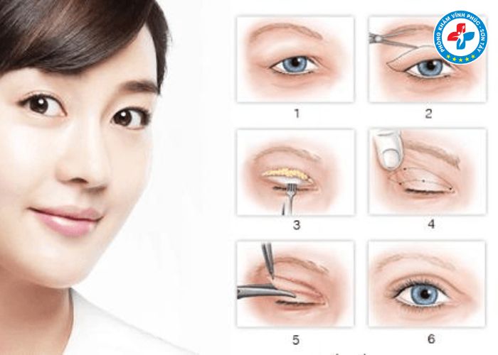 Cắt mí tại Vĩnh Phúc (3) Cắt mí tại Vĩnh Phúc (3)