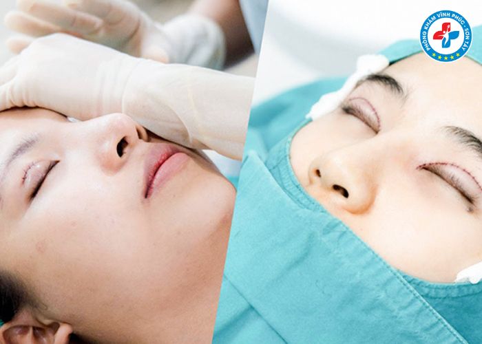 Cắt mí tại Vĩnh Phúc (5) Cắt mí tại Vĩnh Phúc (5)