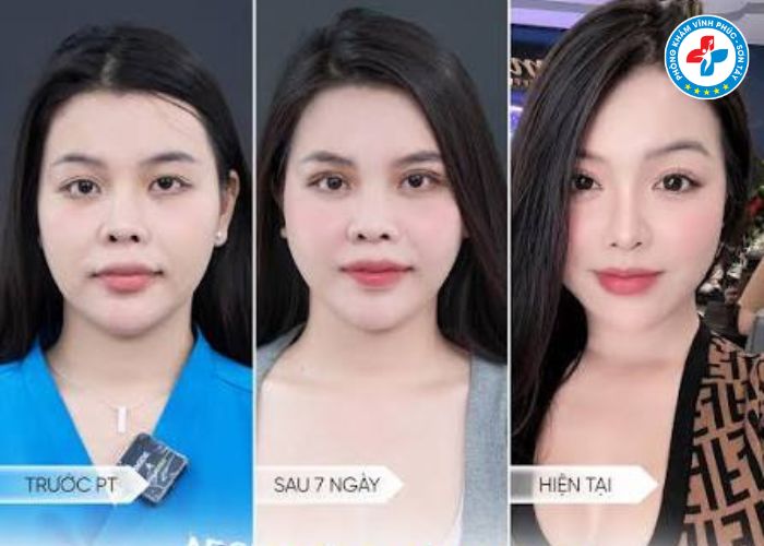 Cắt mí tại Vĩnh Phúc (6) Cắt mí tại Vĩnh Phúc (6)