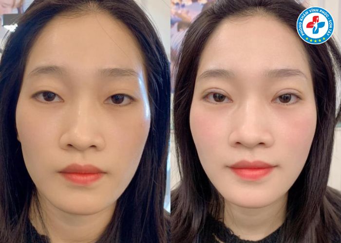 Cắt mí tại Vĩnh Phúc Cắt mí tại Vĩnh Phúc
