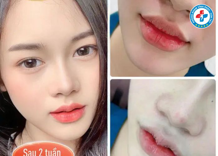 Cắt môi trái tim tại Vĩnh Phúc (3)