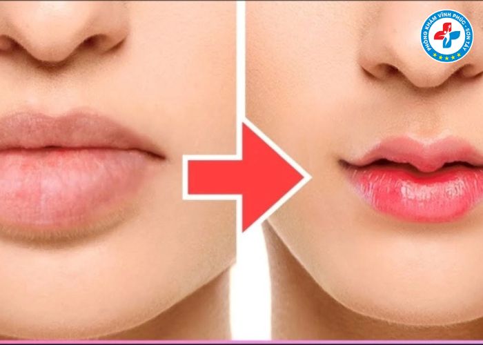 Cắt môi trái tim tại Vĩnh Phúc (6)