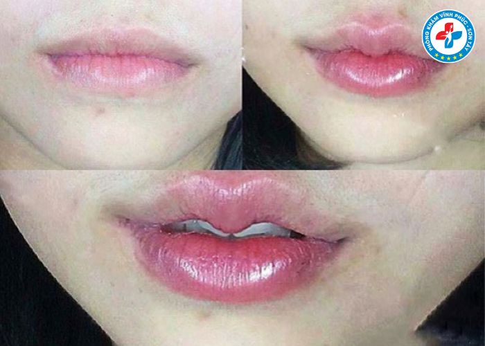 Cắt môi trái tim tại Vĩnh Phúc