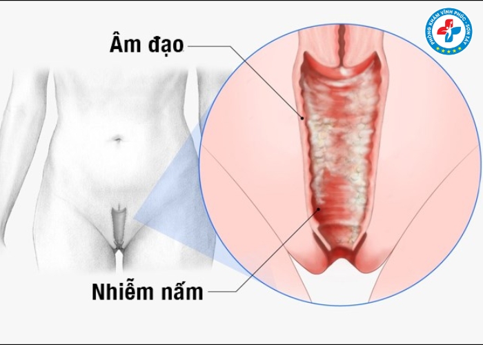 Dấu hiệu bị nấm âm đạo và cách xử lý tại nhà (6) Dấu hiệu bị nấm âm đạo và cách xử lý tại nhà (6)