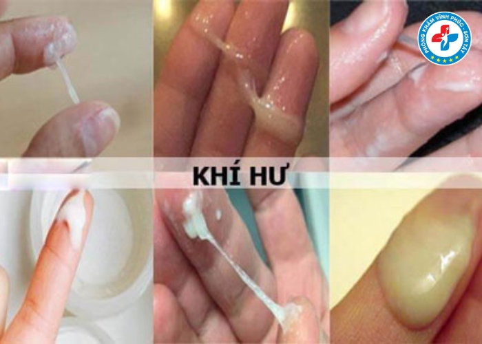 Dấu hiệu viêm nhiễm phụ khoa giai đoạn đầu (2)