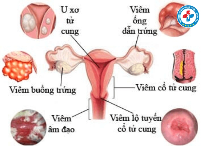 Dấu hiệu viêm nhiễm phụ khoa giai đoạn đầu (5)