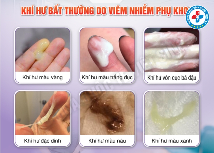 Dấu hiệu viêm nhiễm phụ khoa giai đoạn đầu (6)