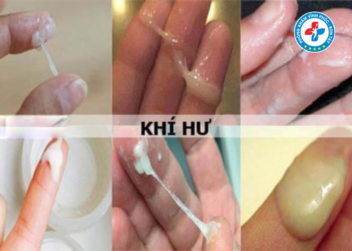 Dấu hiệu viêm nhiễm phụ khoa nhẹ Dấu hiệu viêm nhiễm phụ khoa nhẹ