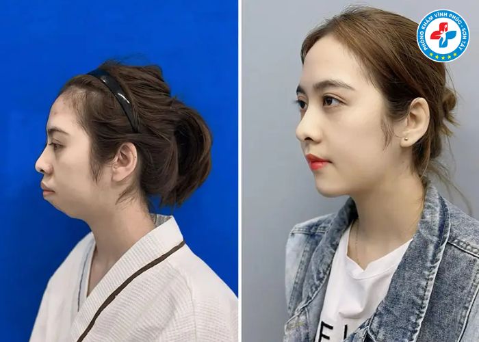 Độn cằm tại Vĩnh Phúc (2) Độn cằm tại Vĩnh Phúc (2)