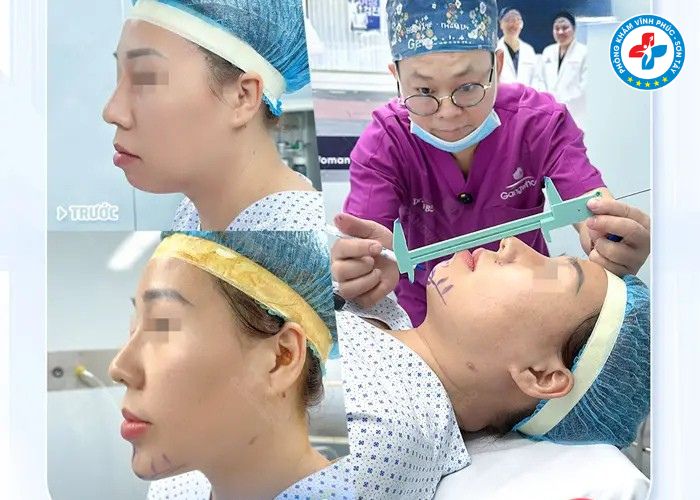 Độn cằm tại Vĩnh Phúc (3) Độn cằm tại Vĩnh Phúc (3)