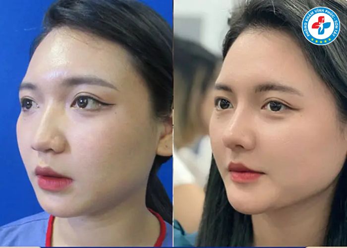 Độn cằm tại Vĩnh Phúc (6) Độn cằm tại Vĩnh Phúc (6)