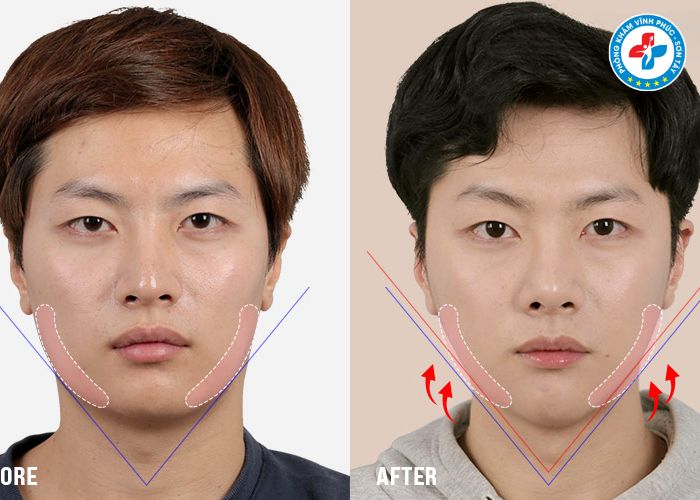 Độn cằm tại Vĩnh Phúc Độn cằm tại Vĩnh Phúc