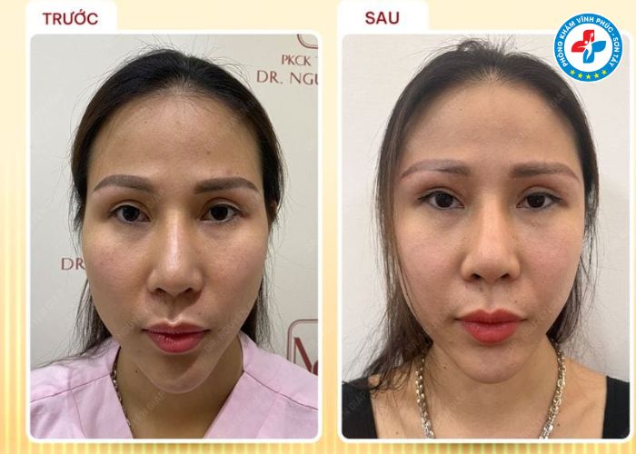 Độn thái dương tại Vĩnh Phúc