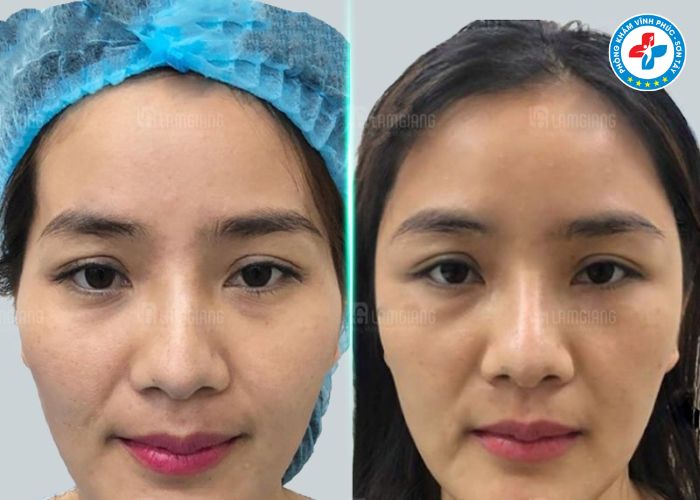 Độn thái dương tại Vĩnh Phúc (2)