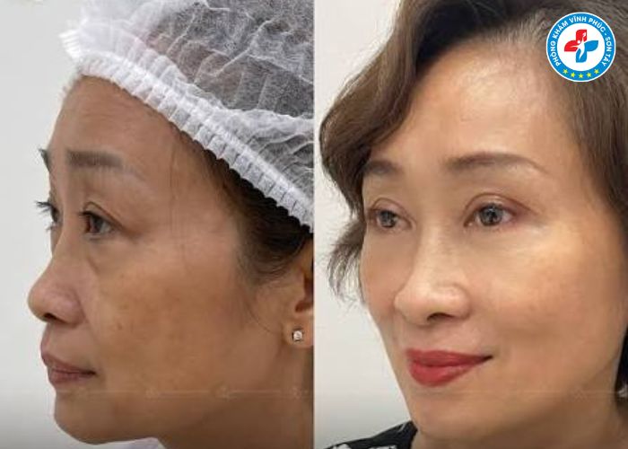 Độn thái dương tại Vĩnh Phúc (5)