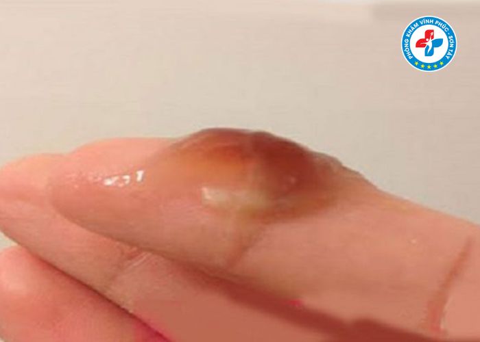 Khí hư màu nâu không mùi là bệnh gì Khí hư màu nâu không mùi là bệnh gì
