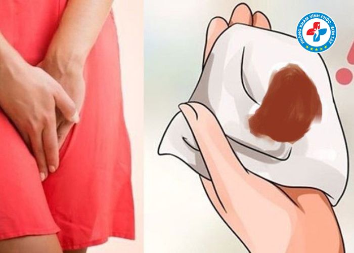 Khí hư màu nâu không mùi là bệnh gì (3) Khí hư màu nâu không mùi là bệnh gì (3)