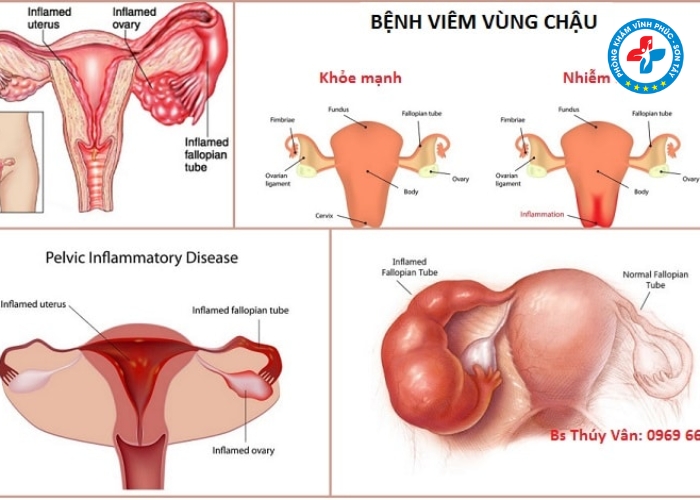 Khí hư màu xanh có mùi hôi là bệnh gì (3)