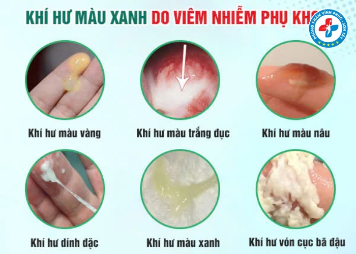 Khí hư màu xanh có mùi hôi là bệnh gì (4)