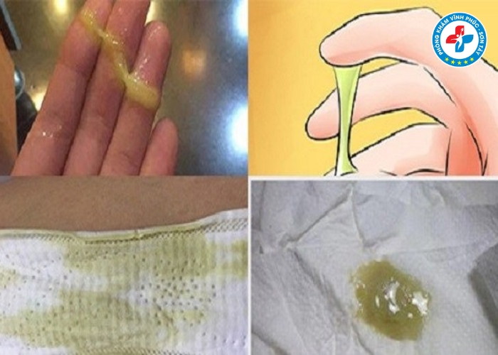 Khí hư màu xanh có mùi hôi là bệnh gì