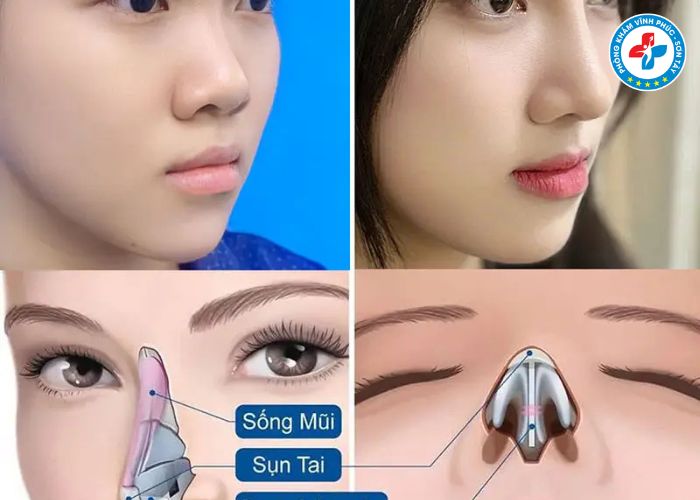 Nâng mũi bán phần tại Vĩnh Phúc (2) Nâng mũi bán phần tại Vĩnh Phúc (2)