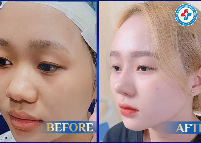 Nâng mũi bán phần tại Vĩnh Phúc (3) Nâng mũi bán phần tại Vĩnh Phúc (3)