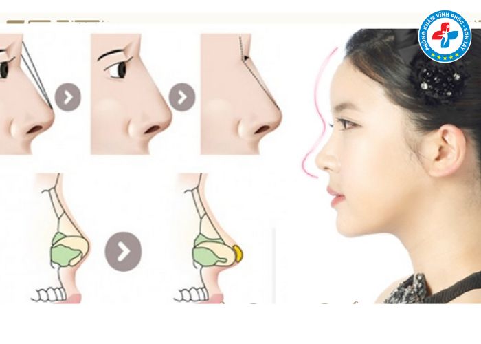 Nâng mũi bán phần tại Vĩnh Phúc (4) Nâng mũi bán phần tại Vĩnh Phúc (4)
