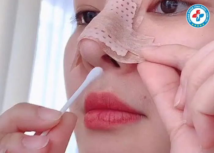 Nâng mũi bán phần tại Vĩnh Phúc (5) Nâng mũi bán phần tại Vĩnh Phúc (5)