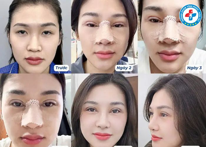 Nâng mũi bán phần tại Vĩnh Phúc (6) Nâng mũi bán phần tại Vĩnh Phúc (6)
