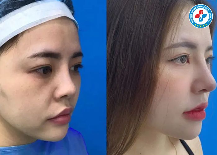 Nâng mũi bán phần tại Vĩnh Phúc Nâng mũi bán phần tại Vĩnh Phúc