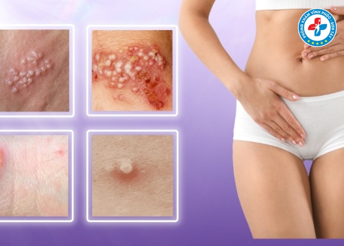 Ngứa vùng kín về đêm phải làm sao (4) Ngứa vùng kín về đêm phải làm sao (4)