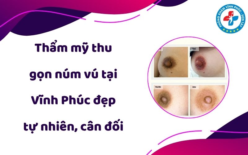 Thẩm mỹ thu gọn núm vú tại Vĩnh Phúc