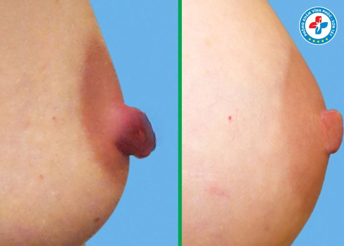 Thẩm mỹ thu gọn núm vú tại Vĩnh Phúc (3) Thẩm mỹ thu gọn núm vú tại Vĩnh Phúc (3)