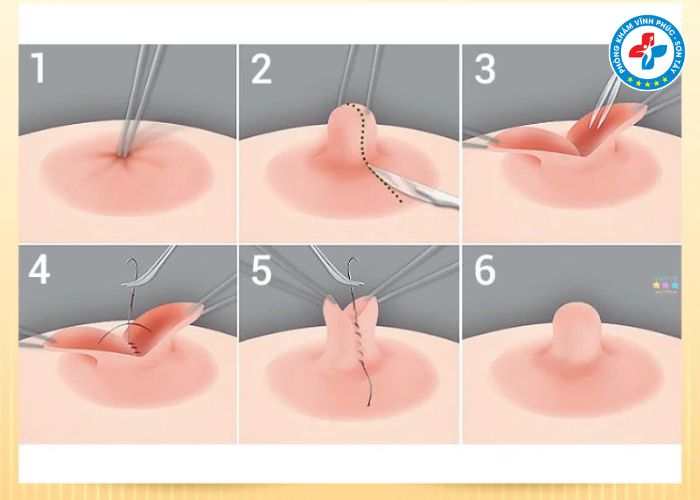 Thẩm mỹ thu gọn núm vú tại Vĩnh Phúc (4) Thẩm mỹ thu gọn núm vú tại Vĩnh Phúc (4)