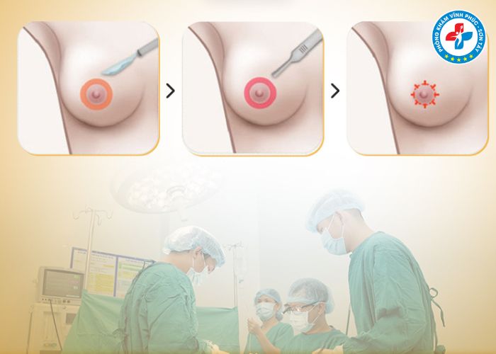 Thẩm mỹ thu gọn núm vú tại Vĩnh Phúc (5) Thẩm mỹ thu gọn núm vú tại Vĩnh Phúc (5)