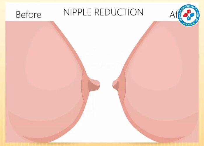 Thẩm mỹ thu gọn núm vú tại Vĩnh Phúc (6) Thẩm mỹ thu gọn núm vú tại Vĩnh Phúc (6)
