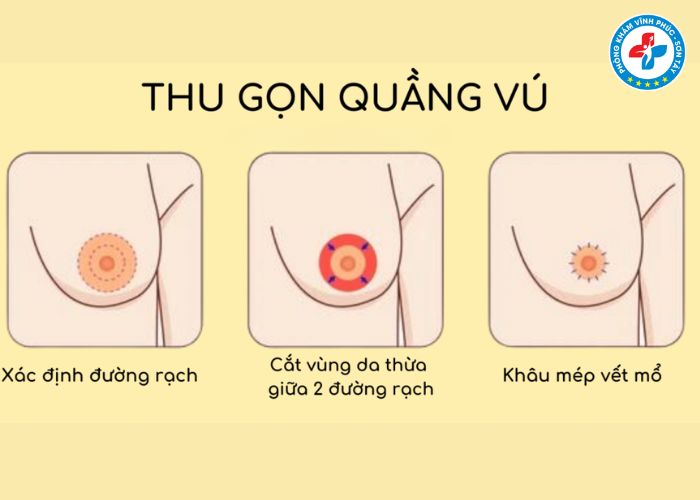 Thẩm mỹ thu gọn quầng thâm vú tại Vĩnh Phúc (2)