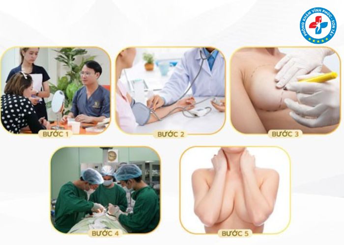 Thẩm mỹ thu gọn quầng thâm vú tại Vĩnh Phúc (4)
