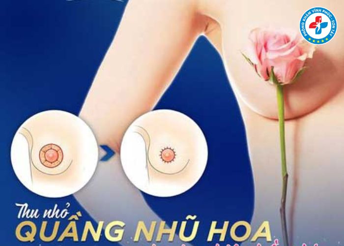 Thẩm mỹ thu gọn quầng thâm vú tại Vĩnh Phúc (5)