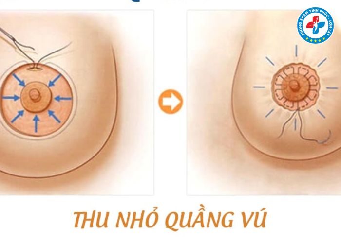Thẩm mỹ thu gọn quầng thâm vú tại Vĩnh Phúc (6)
