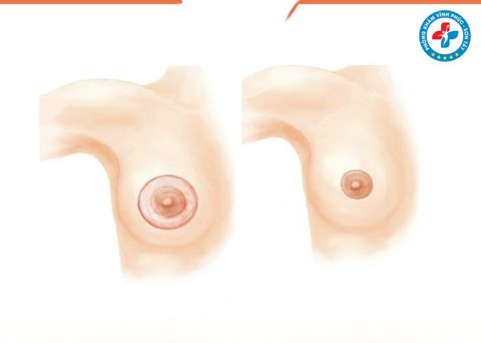Thẩm mỹ thu gọn quầng thâm vú tại Vĩnh Phúc