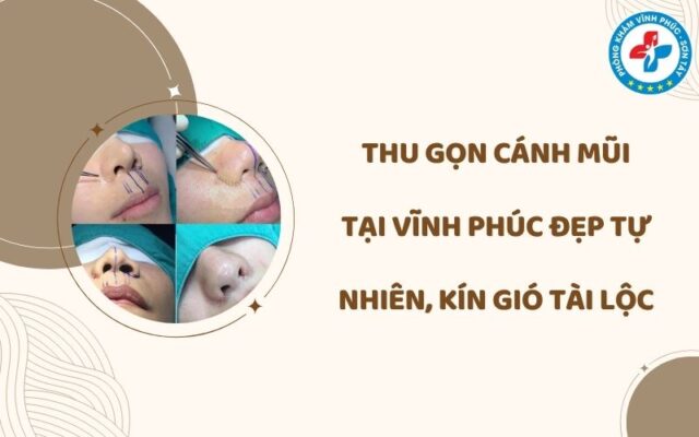 Thu gọn cánh mũi tại Vĩnh Phúc