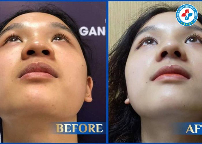Thu gọn cánh mũi tại Vĩnh Phúc (3) Thu gọn cánh mũi tại Vĩnh Phúc (3)