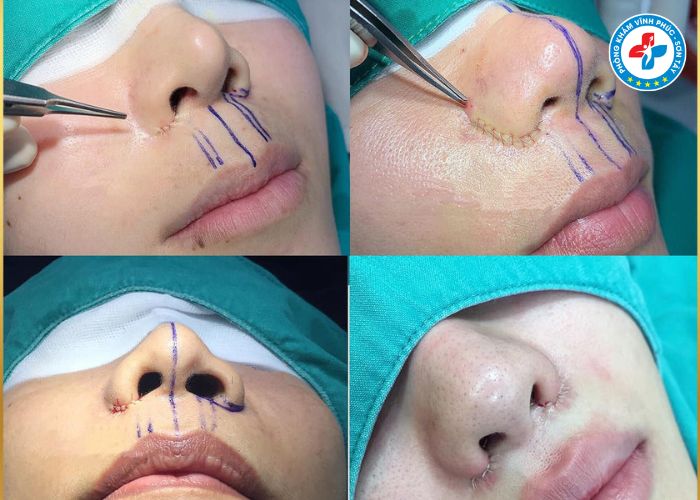 Thu gọn cánh mũi tại Vĩnh Phúc (4) Thu gọn cánh mũi tại Vĩnh Phúc (4)