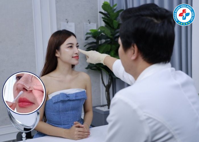 Thu gọn cánh mũi tại Vĩnh Phúc (5) Thu gọn cánh mũi tại Vĩnh Phúc (5)