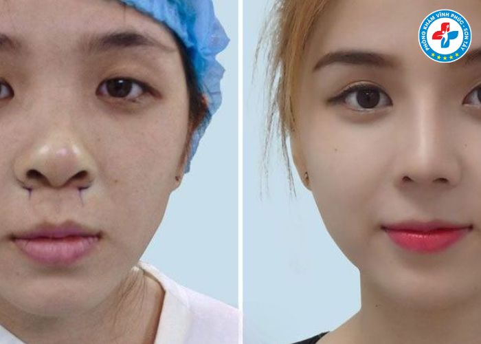 Thu gọn cánh mũi tại Vĩnh Phúc (6) Thu gọn cánh mũi tại Vĩnh Phúc (6)