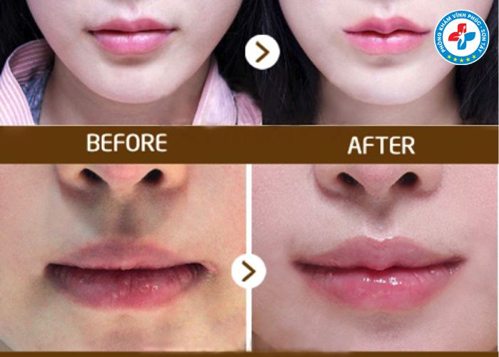 Tiêm môi tại Vĩnh Phúc (5) Tiêm môi tại Vĩnh Phúc (5)