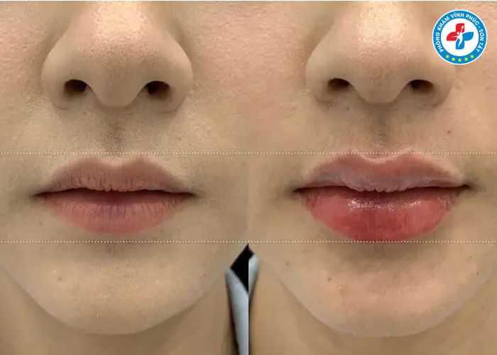 Tiêm môi tại Vĩnh Phúc Tiêm môi tại Vĩnh Phúc